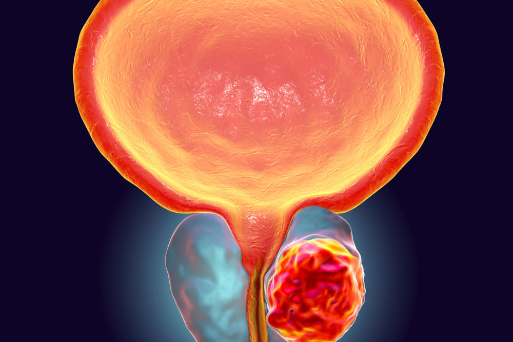 Cáncer de próstata en zona metropolitana de Guadalajara : Detección temprana y tratamiento especializado